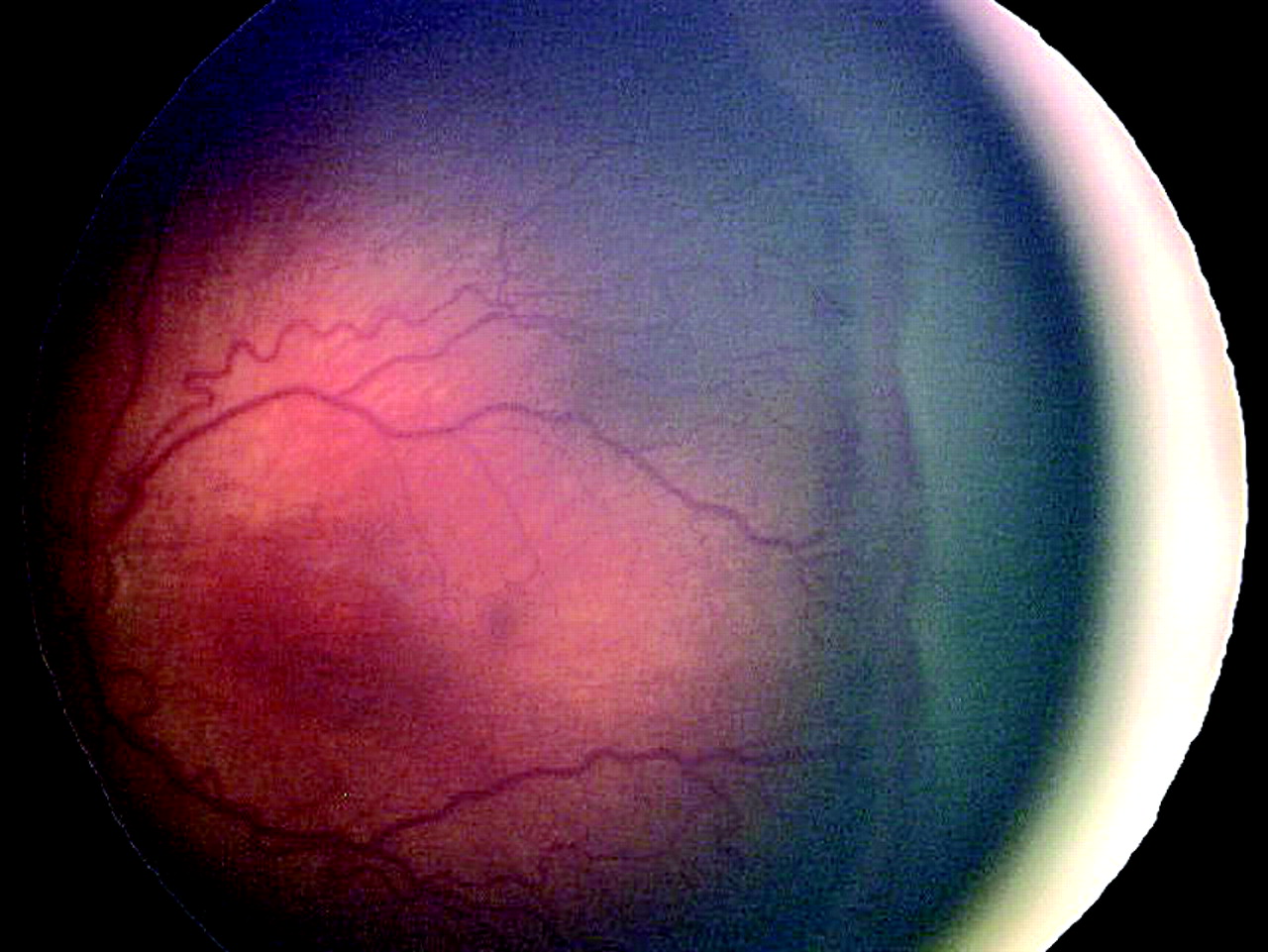 ROP retinopathy of prematurity and deep learning AI