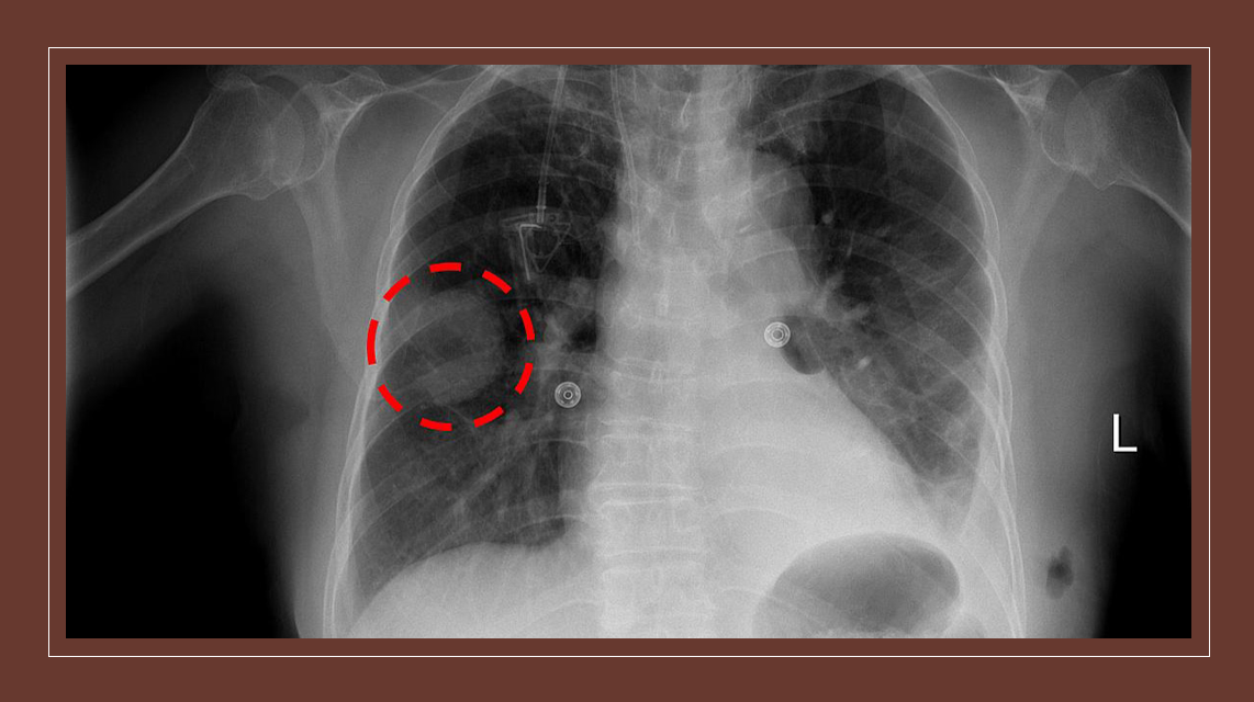 Healthcare Technology Digital Innovations - Artificial intelligence predicts risk for lung cancer from chest x-rays